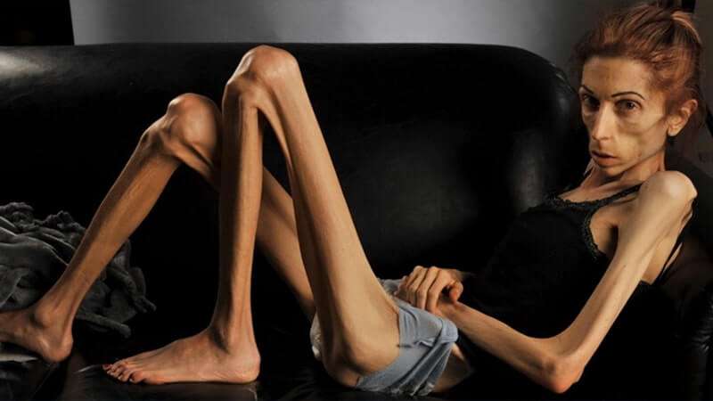 Anorexia โรคคลั่งผอม 